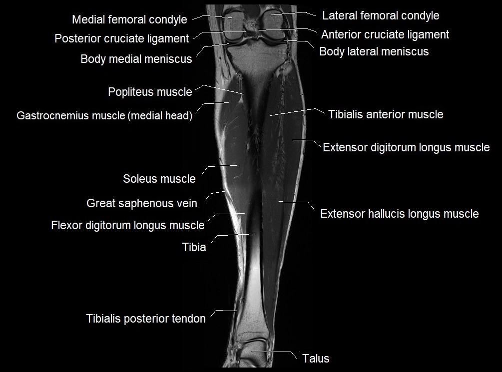 MRI 3T leg (tibia & fibula) labelled coronal cross sectional anatomy image 15.webp